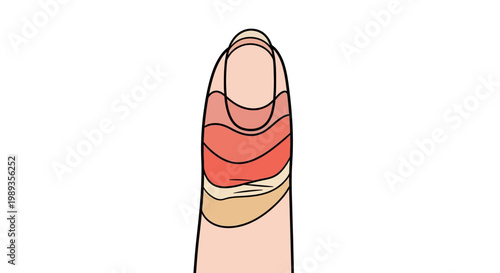 Illustration of a human finger showing layers of skin infection or inflammation.