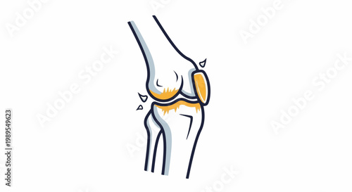 Stylized illustration of a human knee joint, highlighting cartilage and fluid