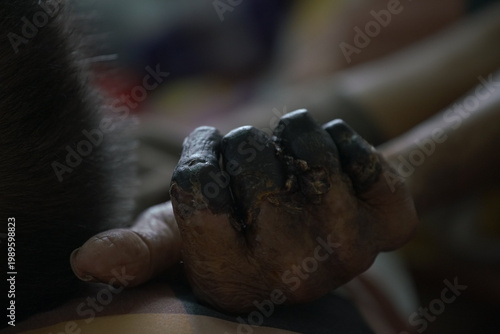 showing third-degree frostbite, or congelatio gangraenosa, on a human hand. This is the most severe stage of frostbite.  Congelatio gangraenosa involves irreversible damage to the skin, muscles