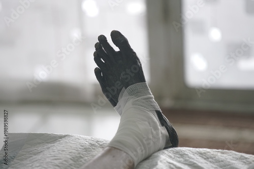 Close-up photograph of a severely gangrenous foot with necrotic tissue, wrapped in white medical bandage and resting on a hospital bed. The darkened, blackened toes and foot indicate advanced diabetic