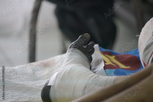 Close-up photograph of a severely gangrenous foot with necrotic tissue, wrapped in white medical bandage and resting on a hospital bed. The darkened, blackened toes and foot indicate advanced diabetic