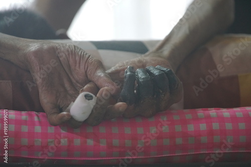 showing third-degree frostbite, or congelatio gangraenosa, on a human hand. This is the most severe stage of frostbite.  Congelatio gangraenosa involves irreversible damage to the skin, muscles