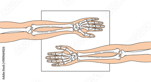 Human forearm and hand skeletal structure is illustrated in an x-ray style showing bones like radius, ulna, carpals, and phalanges.