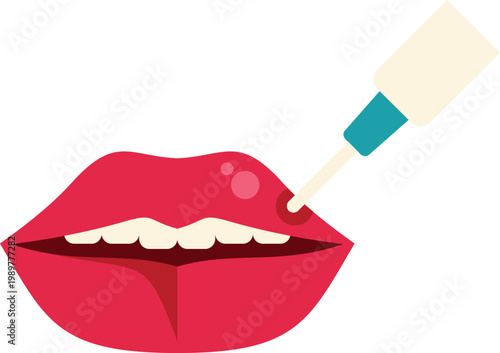 Lips with a cold sore receiving topical cream for treatment