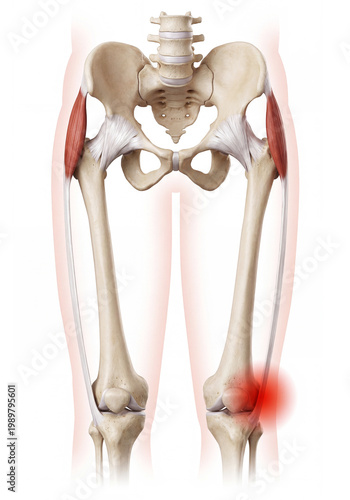 Iliotibial Band Syndrome . IT Band Pain at Knee with Tensor Fasciae Latae and Femur Anatomy Diagram