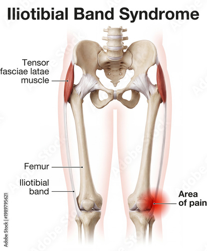 Iliotibial Band Syndrome . IT Band Pain at Knee with Tensor Fasciae Latae and Femur Anatomy Diagram