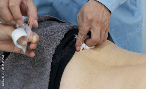 Canvastavla Doctor's hands placing acupuncture needles into patient's lower back while holding cotton swab, close-up medical procedure