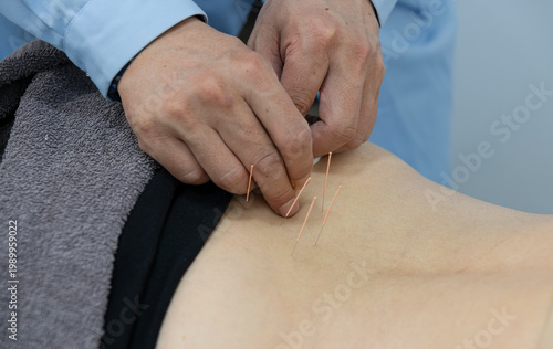 Cuadro en lienzo Doctor's hands placing acupuncture needles into patient's lower back while holding cotton swab, close-up medical procedure