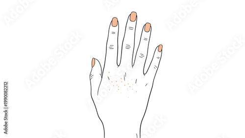 Illustration of the back of a human hand showing symptoms of a skin rash or allergic reaction with small red spots on the skin surface.