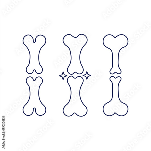 Illustration of bone fracture and healing process with internal fixation