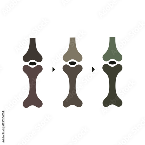 Stages of a knee joint replacement prosthetic fitting process