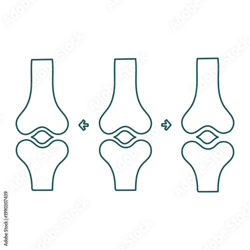 Illustration of knee joint movement and prosthetic alignment variations