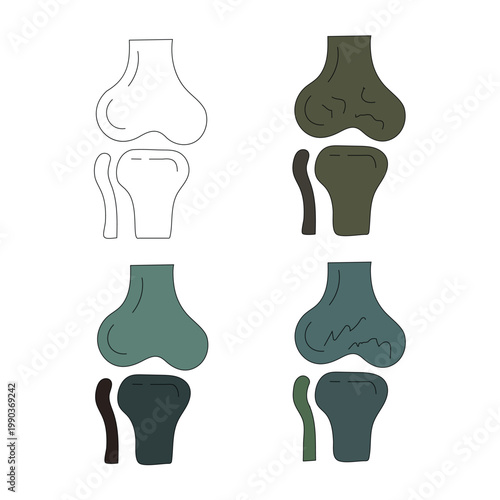 Illustrations of knee joint conditions and replacements from different perspectives
