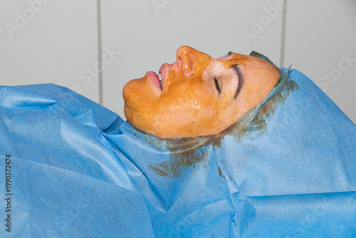 Antiseptic treatment before the thread facelift procedure.
