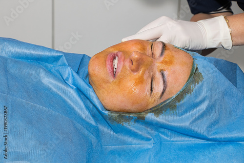 Antiseptic treatment before the thread facelift procedure.