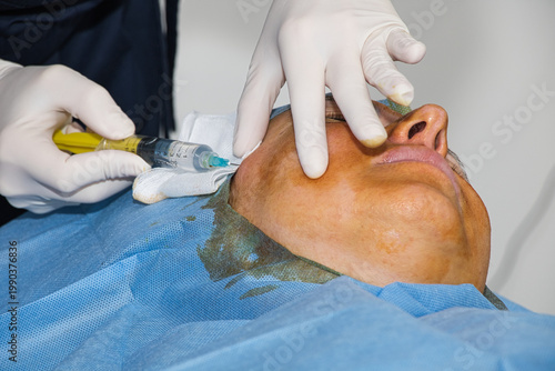 Anesthesia administered before a facelift using absorbable threads. Close-up.