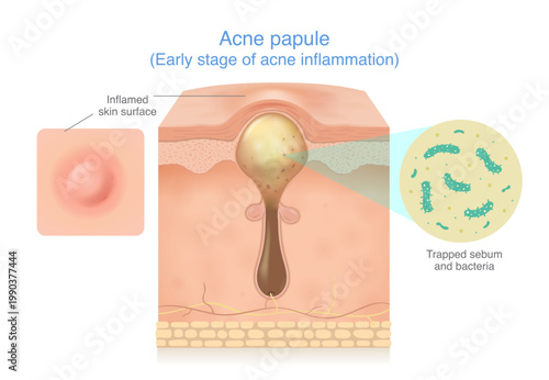 Obraz na plátně Skin layer anatomy of papule acne at 2 side have close up of inflamed skin surface small red and clogged pore by trapped sebum and bacteria