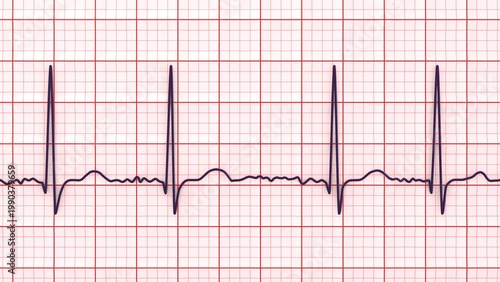 Fotografía Atrial fibrillation ECG, 3D illustration, electrocardiogram tracing showing irregularly irregular rhythm without distinct P waves