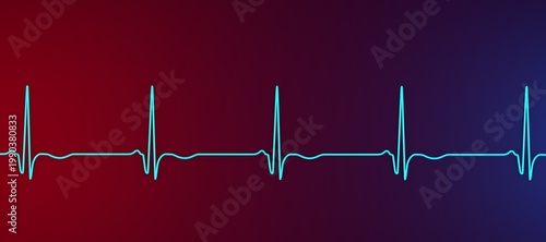 Photos Chronic Q wave ECG, 3D illustration, electrocardiogram pattern showing persistent pathological Q wave and chronic myocardial scar after infarction