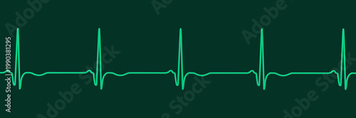 Tableau sur toile Chronic Q wave ECG, 3D illustration, electrocardiogram pattern showing persistent pathological Q wave and chronic myocardial scar after infarction