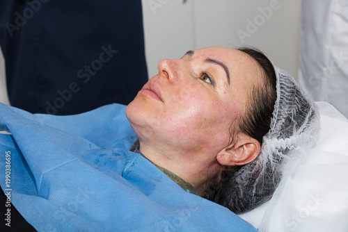 Close-up of an adult woman's face immediately after a thread lift procedure.