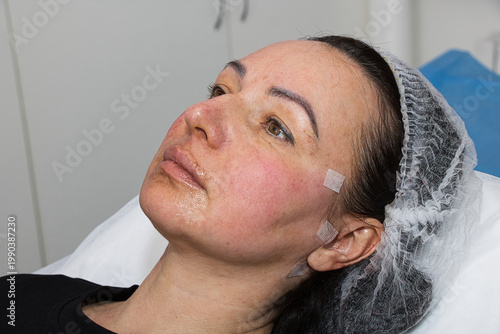 Close-up of an adult woman's face immediately after a thread lift procedure.