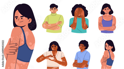 Flat illustration set of people with vitiligo showing diverse skin conditions and body positivity. Ideal for health, identity, equality concepts, diversity, dermatology awareness empowerment.