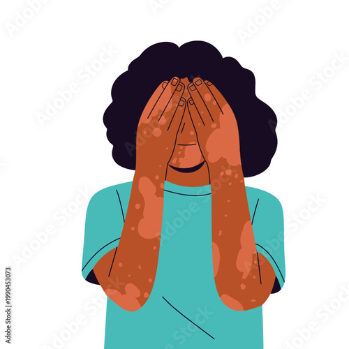 Flat illustration of people with vitiligo showing diverse skin conditions and body positivity. Ideal for health, identity, equality concepts, diversity, dermatology awareness empowerment.