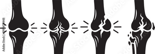 Progression of knee joint degradation, from healthy to severe damage, showing cracking and crumbling bone structure over time.