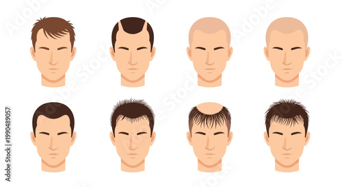 Vector illustration showing various stages of male hair loss treatment on white background