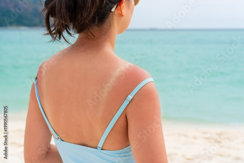 Sunburned skin on shoulder and back of a woman. Red skin sun burn after sunbathing at the beach