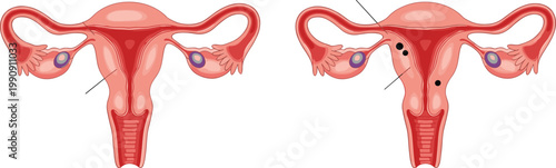 Female reproductive system uterus anatomy comparison vector showing healthy uterus and abnormal uterus with endometriosis or fibroids for gynecology education