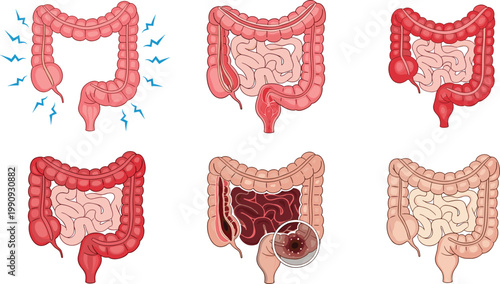 Human Colon Disease Stages Illustration Set Showing Digestive System Disorders, Intestinal Inflammation, Infection, and Medical Anatomy Vector Diagrams for Healthcare Education