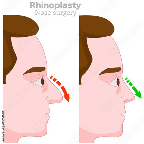 Nose surgery job, rhinoplasty, surgical procedure, before after. Shape size problem. Man facial front view. Illustration vector