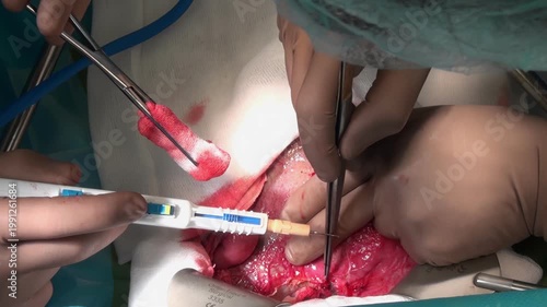 Experienced surgeons perform a liver resection procedure inside a hospital surgery room. Medical equipment is being used in this delicate, daytime operation.