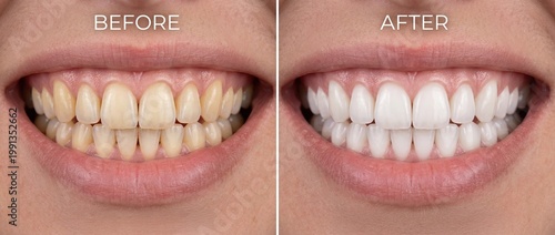 Teeth Whitening Before and After Smile Comparison Close Up