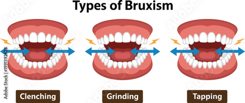 Medical dental infographic vector showing types of bruxism including teeth clenching grinding and tapping for dentistry education oral health posters and orthodontic treatment patient guides
