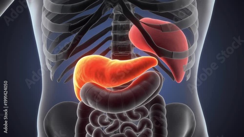 3D Medical Animation of Inflamed Pancreas for Acute Pancreatitis