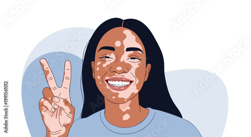 Portrait of a beautiful smiling woman with vitiligo skin condition making a peace sign against a soft blue background.
