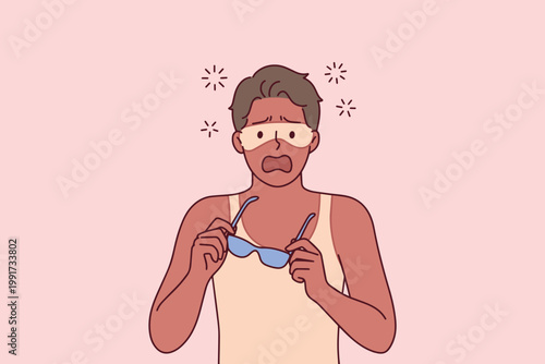 Man suffering from severe sunburn with visible tan lines from sunglasses and clothes. Concept of skin damage, UV protection failure, and beach safety.
