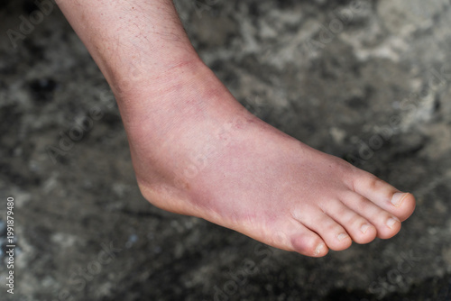 Swollen Foot After Cast Removal of Metatarsal Fracture