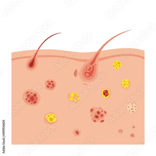 Cross-section of human skin illustrating various types of acne lesions and hair follicles.