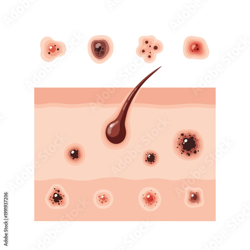 Detailed illustration of various skin conditions, moles, and a hair follicle in a cross-section of human skin.