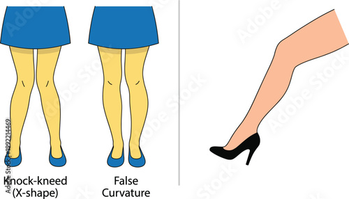 Knock knee leg alignment comparison false curvature high heel posture illustration medical infographic vector isolated design