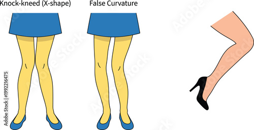 Knock knee X shape and false curvature leg comparison high heels posture medical vector illustration isolated