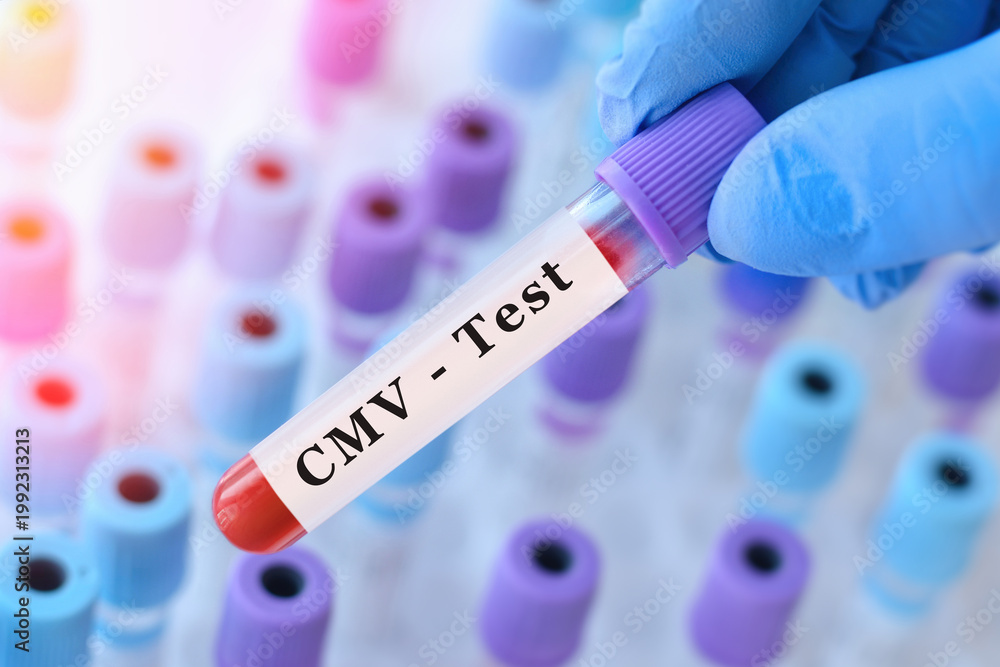 Fototapeta premium Doctor holding CMV blood test tube explaining detection of cytomegalovirus infection, immune response evaluation and viral diagnostics in clinical laboratory testing