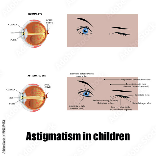 Astigmatism in children: an oval cornea causes blurred vision. 