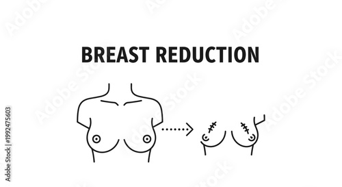 Breast Reduction Surgery Medical Illustration: Before and After Concept.