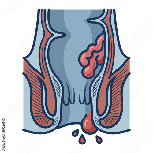 Hemorrhoids Piles and Rectal Bleeding Medical Illustration