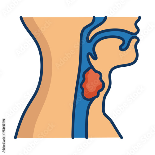 Throat Cancer Tumor and Larynx Oncology Illustration